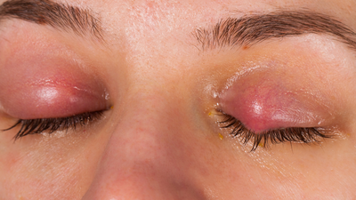 Tips to quickly cure eye flu and also prevent the pink eye infection