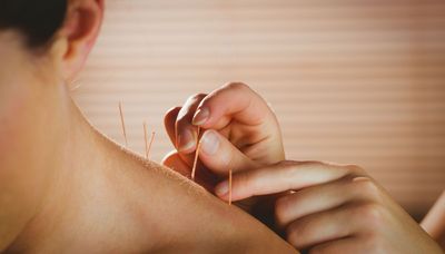How does acupuncture work, and why do so many people swear by it?