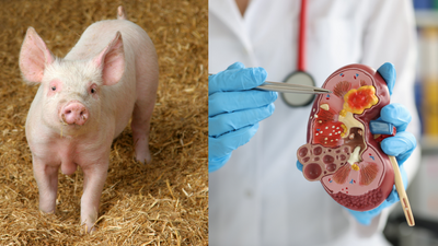 Pig kidney transplanted in human body continues to function, Scientists call it a breakthrough