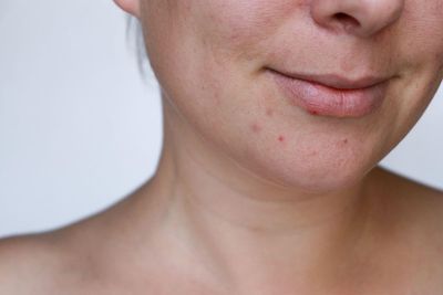 How can you get rid of acne scars? From serums to laser treatments, experts talk through the options