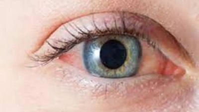 Conjunctivitis patients show 84% positivity for human enteroviruses: AIIMS Raipur study