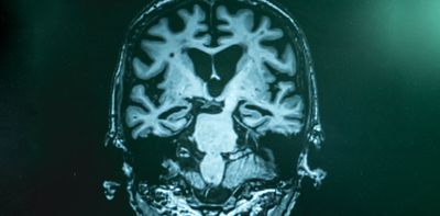 Setting the stage for a better understanding of complex brain disorders