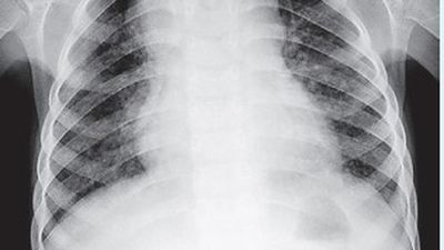 Missed childhood TB cases impede achieving 2025 goal