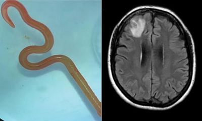 ‘Oh my god’: live worm found in Australian woman’s brain in world-first discovery