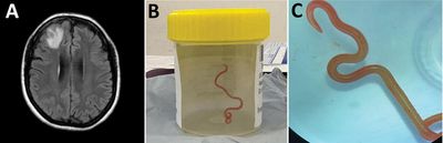 Live parasitic worm found in Australian woman’s brain in world first