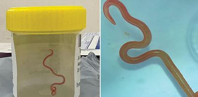 Finding a live brain worm is rare. 4 ways to protect yourself from more common parasites