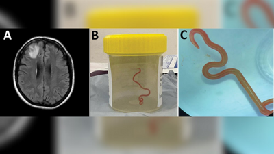 Australia woman's brain invaded by parasitic worm that normally infects pythons