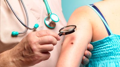 Skin cancer: Causes, types, prevention and treatment