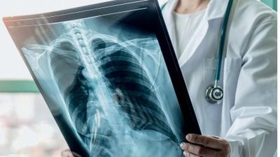 Chest X-ray interpretation using AI can detect more TB cases