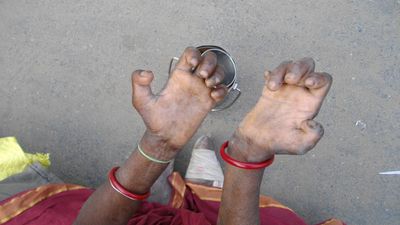India reports far fewer people with orphan diseases