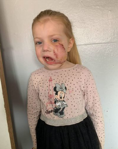 ‘An XL Bully disfigured my daughter - this is why we should ban the breed’