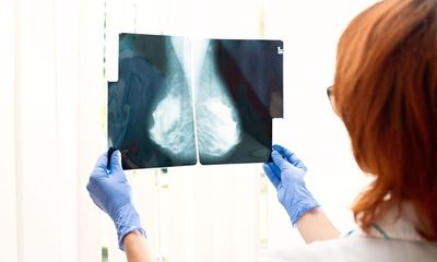 Consumer genetic test results ‘causing unnecessary breast cancer alarm’