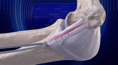 The TNF broadcast tried being way too immersive with a graphic Brock Purdy surgery animation