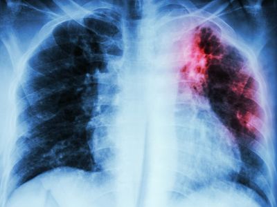 Warning over surge in Tuberculosis as progress in eliminating disease ‘stalls’