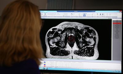 Radiotherapy doses for prostate cancer could be cut by three-quarters, trial finds