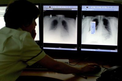 Computer modelling ‘could simplify lung cancer screening’