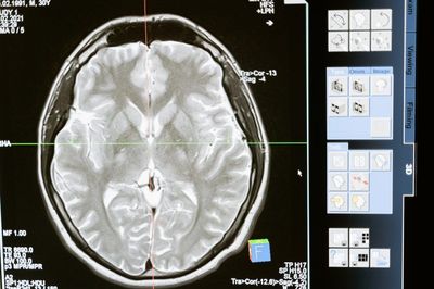 Scientists 3D Print Human Stem Cells To Repair Brain Injuries