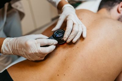 Melanoma ‘no longer the leading cause of skin cancer deaths’