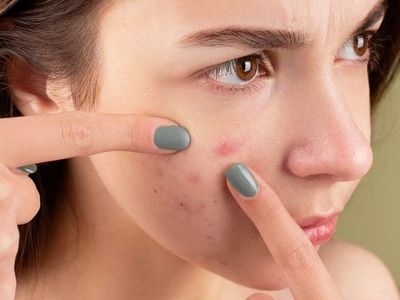 Acne Significantly Affects Perception Of Attractiveness, Trustworthiness, And Success, Study Finds