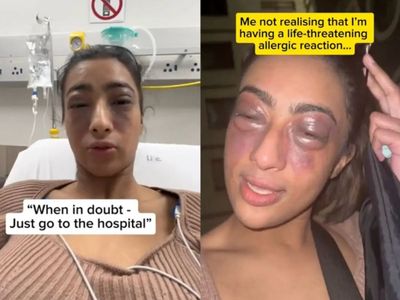 Influencer delays using epipen to film ‘life-threatening’ allergic reaction for her followers
