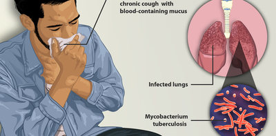 Indonesia needs to triple its funding to control tuberculosis – here's where to start