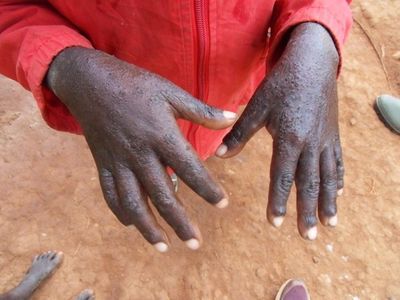 Malawi battles outbreak of scabies that health experts link to climate crisis