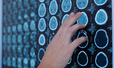 Finger-prick test could help spot brain cancer recurrence sooner