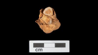 Rare tumor with teeth discovered in Egyptian burial from 3,000 years ago