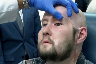 Man receives the first eye transplant plus a new face. It's a step toward one day restoring sight