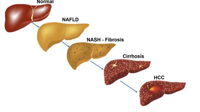 Paying attention to the resolute link between diabetes and the liver