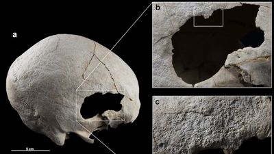 Copper Age woman survived two skull surgeries up to 4,500 years ago