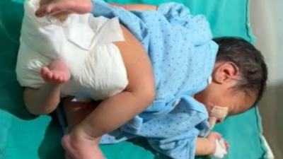 Uttar Pradesh: Baby with four hands & four legs born in Muzaffarnagar