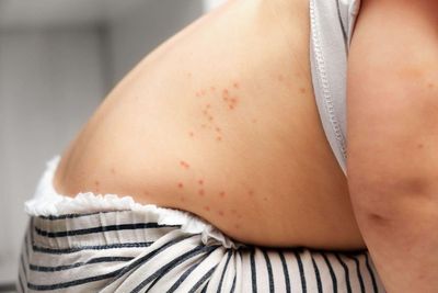 Childhood chickenpox vaccine recommended for use on the NHS
