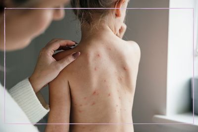 Wondering whether your child should get the chickenpox vaccine? It could become available on the NHS - here's why
