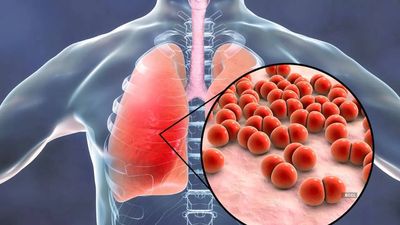 What is fungal pneumonia? Learn about its symptoms, risk groups, occurrence, and management