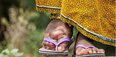 Patients' beliefs about illness matter: the case of elephantiasis in rural Ghana
