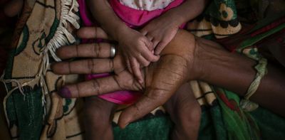 Wasting and edema — severe forms of malnutrition — affect millions of children worldwide as food insecurity grows