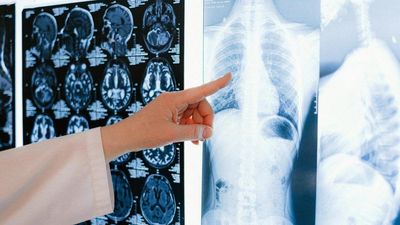 AI Identifies Non-Smokers At Risk Of Lung Cancer