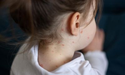 ‘No no no. Avoid them all’: anti-vaccine conspiracies spread as UK cases of measles increase