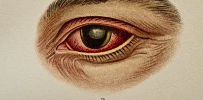 Yes, you can get syphilis of the eye – professor of ophthalmology explains