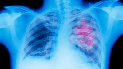 This AI model can tell if you're at high risk of lung cancer by analyzing a single X-ray scan