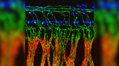 Tinnitus may stem from nerve damage not detectable on hearing tests