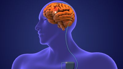 Electrical stimulation could treat traumatic brain injuries