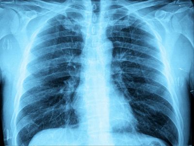 How to understand Ohio’s ‘white lung syndrome’ pneumonia outbreak – and why it’s not linked to China