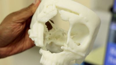 Surgeons Use 3D Printed Model To Save Gran With Rare Cancerous Nose Tumor