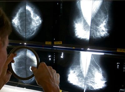 Breast cancer survivors may not need so many mammograms after surgery, UK study suggests