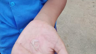 Chhattisgarh: Students suffer burns after teachers allegedly compel them to pour hot oil on each other’s hands