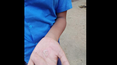 Chhattisgarh students forced to pour hot oil in disturbing punishment, 3 teachers suspended