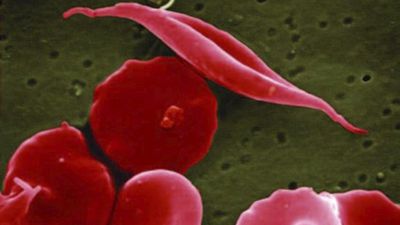 US approves two gene therapies for sickle cell disease