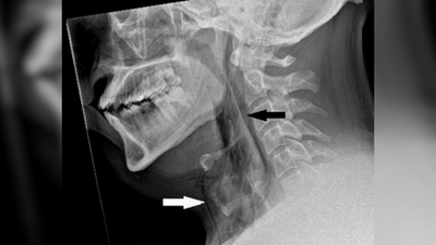 In world's 1st known case, man tears windpipe from holding sneeze